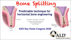 Bone Splitting: Predictable Technique for Horizontal Bone Engineering