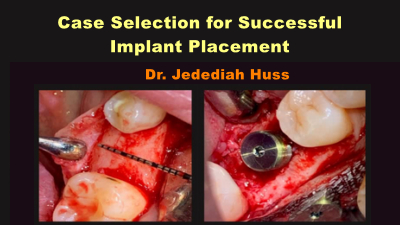 Case Selection for Successful Implant Placement 1 Case Selection for Successful Implant Placement