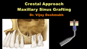 Crestal Approach: Maxillary Sinus Grafting