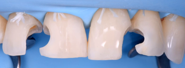 Direct and Indirect Adhesive Restorations 1 Direct and Indirect Adhesive Restorations