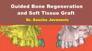 Guided Bone Regeneration and Soft Tissue Graft - Dental Videos