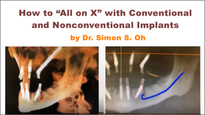 How to “All-on-X” with Conventional and Nonconventional Implants and Bone Reduction Techniques 1 How to “All-on-X” with Conventional and Nonconventional Implants and Bone Reduction Techniques