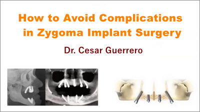 How to Avoid Complications in Zygoma Implant Surgery 1 How to Avoid Complications in Zygoma Implant Surgery