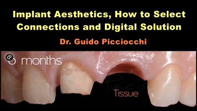 Implant Aesthetics, How to Select Connections and Digital Solution 1 Implant Aesthetics, How to Select Connections and Digital Solution