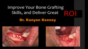 Improve Your Bone Grafting Skills and Deliver a Great ROI for Doctors and Patients