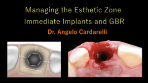Managing the Esthetic Zone Immediate Implants and GBR