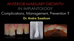 Maxillary Anterior Growth Complications, Management & Prevention in Implantology