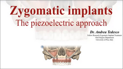 New Zygomatic Implant Minimally Invasive Technique 1 New Zygomatic Implant Minimally Invasive Technique Using Piezoelectric Strumentation