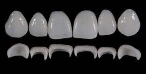 Prosthetic Rehabilitation on Natural Teeth: Predictable, Esthetic and Systematic Steps