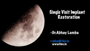 Single Visit Implant Restorations