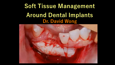 Soft Tissue Management Around Dental Implants 1 Soft Tissue Management Around Dental Implants