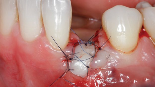 Soft Tissue Management around Natural Teeth and Dental Implants 1 Soft Tissue Management around Natural Teeth and Dental Implants