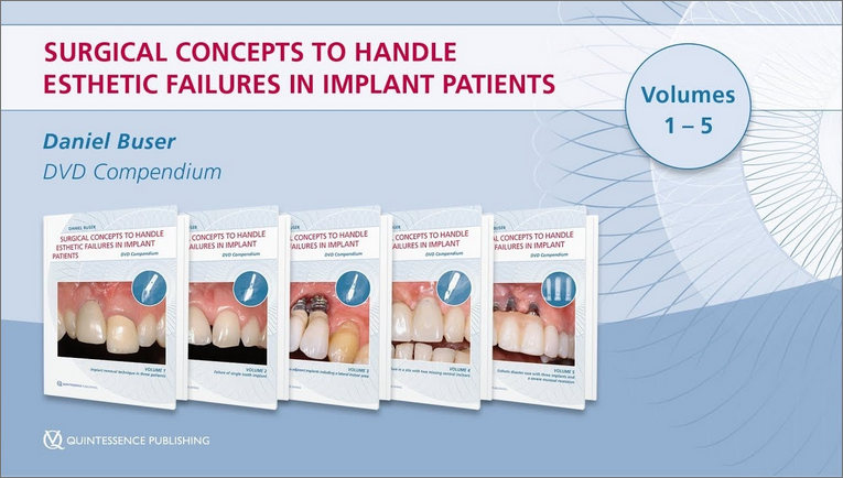 Surgical Concepts to Handle Esthetic Failures in Implant Patients 1 Surgical Concepts to Handle Esthetic Failures in Implant Patients