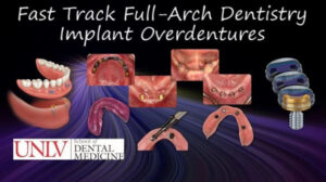 Full-Arch Dentistry – Implant Overdentures