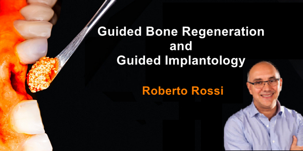 Guided Bone Regeneration And Guided Implantology - Dental Videos