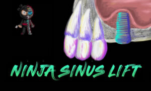 Ninja Sinus Lift