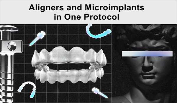Aligners and Microimplants in One Protocol - Dental Videos