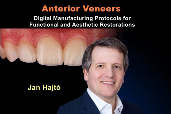 Anterior Veneers: Digital Manufacturing Protocols for Functional and Aesthetic Restorations 1 Anterior Veneers: Digital Manufacturing Protocols for Functional and Aesthetic Restorations