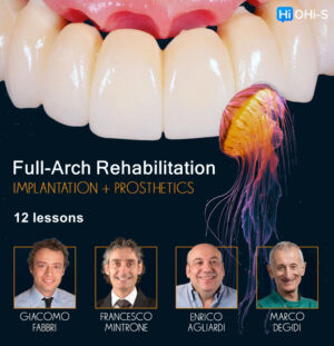 Full-Arch Rehabilitation: Implantation and Prosthetics