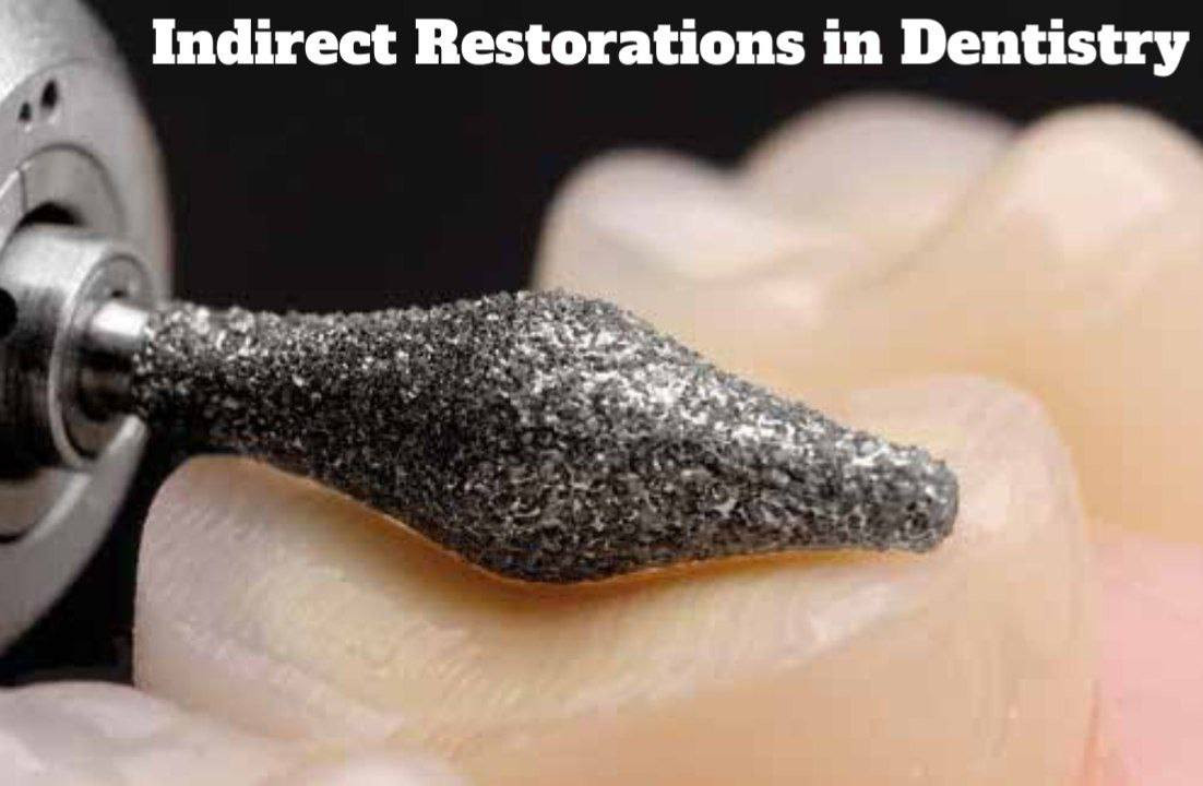 Indirect Restorations in Dentistry – A Complete Guide 1 Indirect Restorations in Dentistry – A Complete Guide