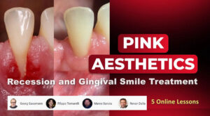 Pink Aesthetics: Recession and Gingival Smile Treatment
